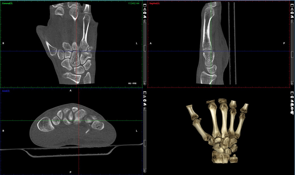 ULD – Ultra low dose with diagnostic image quality