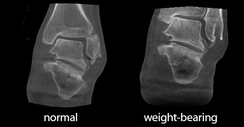 The original weight-bearing CT