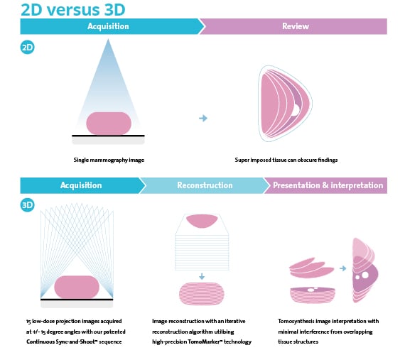 Benefits of digital breast tomosynthesis