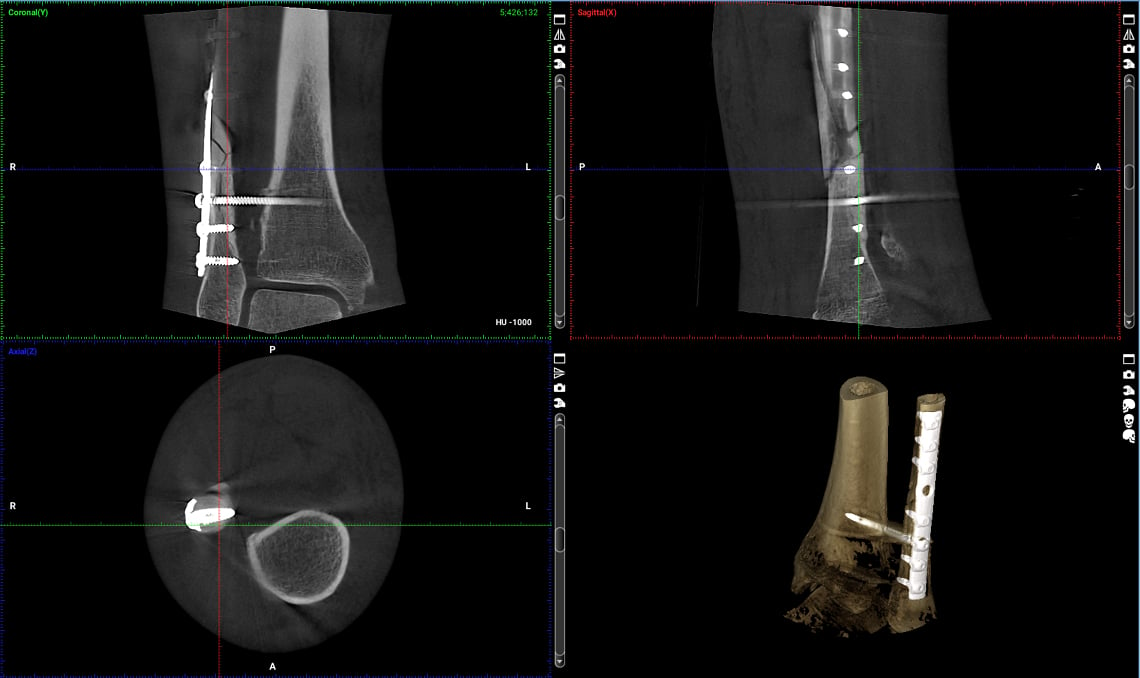 With metal artifact reduction