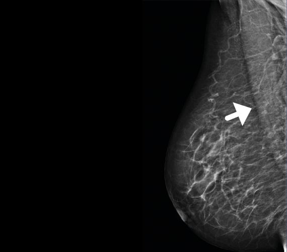 Right Medio-Lateral Oblique with MaxView