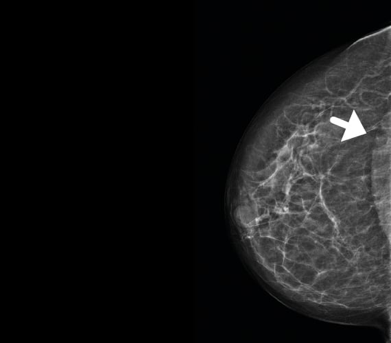 Right cranio caudal view with MaxView